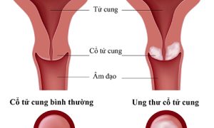 Hỗ Trợ Điều Trị Ung Thư Cổ Tử Cung Bằng Hợp Chất Fucoidan